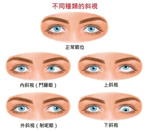 做愛鬥雞眼|斜視、射哩眼和鬥雞眼成因和症狀 如何矯正斜視？ 